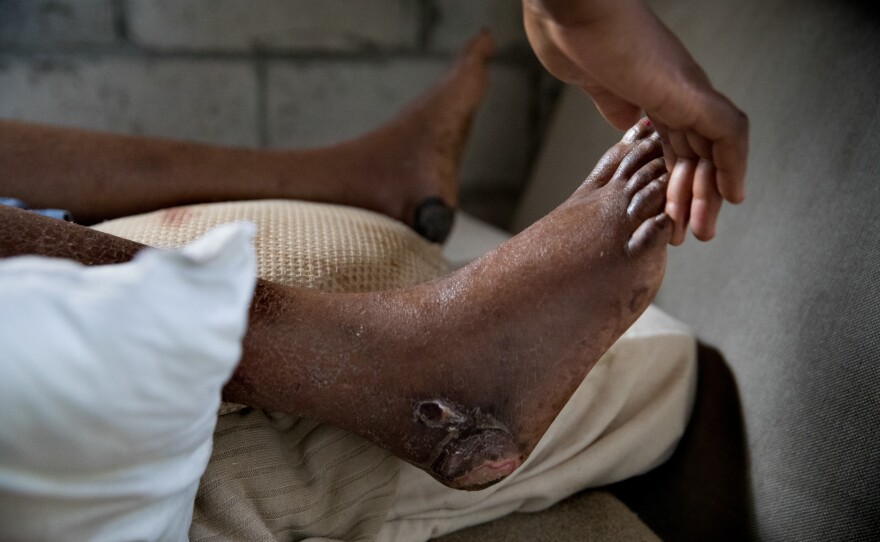 Lacieuse Timothee has sores that are turning black. A doctor diagnosed her with gangrene. She was injured after her home collapsed on her during the hurricane.