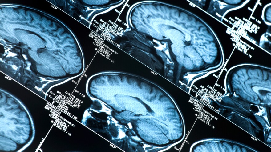 Researchers have only recently been able to use brain scans to detect Alzheimer's risk factors in living people.