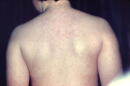 This photograph depicts a posterior view of a young patient’s back, highlighting an erythematous rash associated with measles.
