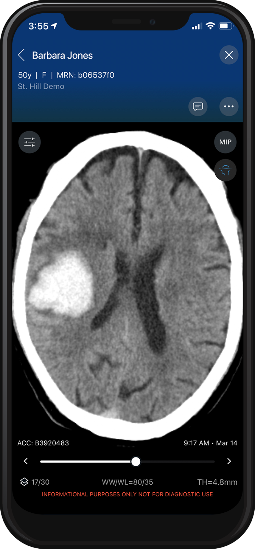 A CAT scan is sent to the cloud and then artificial intelligence analyzes the image and sends pictures of the brain to multiple doctors to assess the situation and plan treatment.