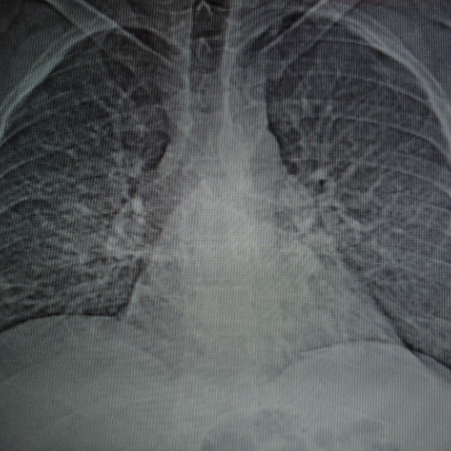 A CT scan shows the damage to Smith's lungs caused by progressive massive fibrosis.