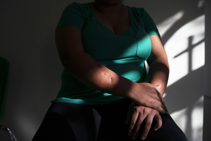 Alejandrina says that when she was 14, a cousin cut her arm and body with a machete after she came out to her family. She and her partner decided to leave Honduras this year. Alejandrina's partner and son were allowed into the U.S. but Alejandrina was sent back to Mexico.