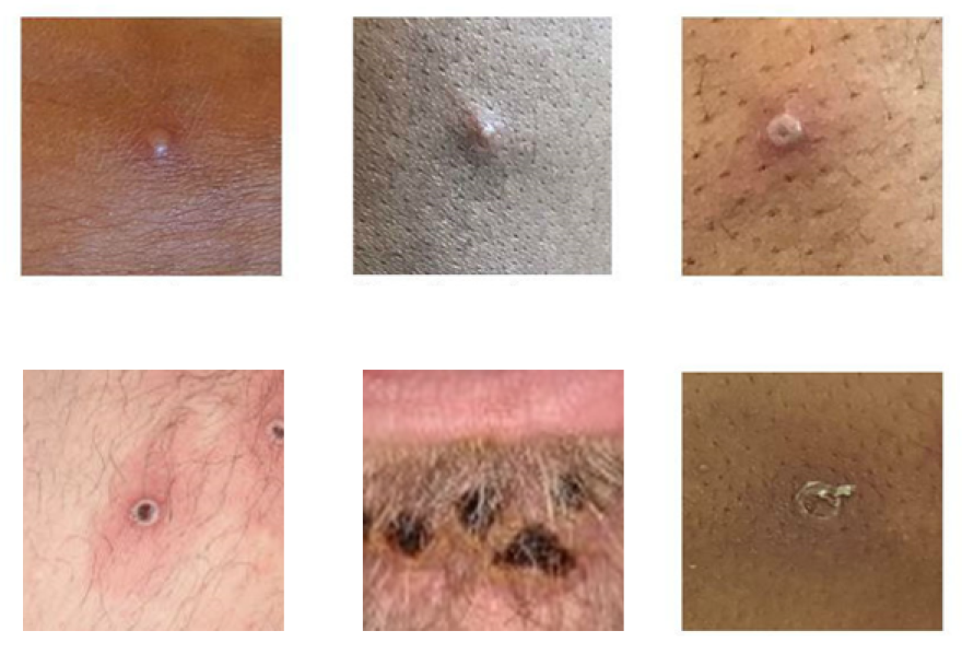 The monkeypox virus causes lesions that can resemble sores from acne, an ingrown hair or other viruses. They are infectious until the scab is fully healed. (UK Health Security Agency/CDC)