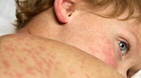 A child's face and upper back area, covered with red spots