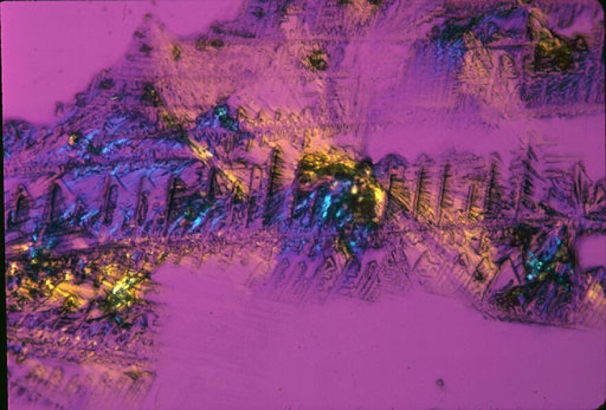 Cisplatin crystals, a platinum compound used to treat testicular cancer.