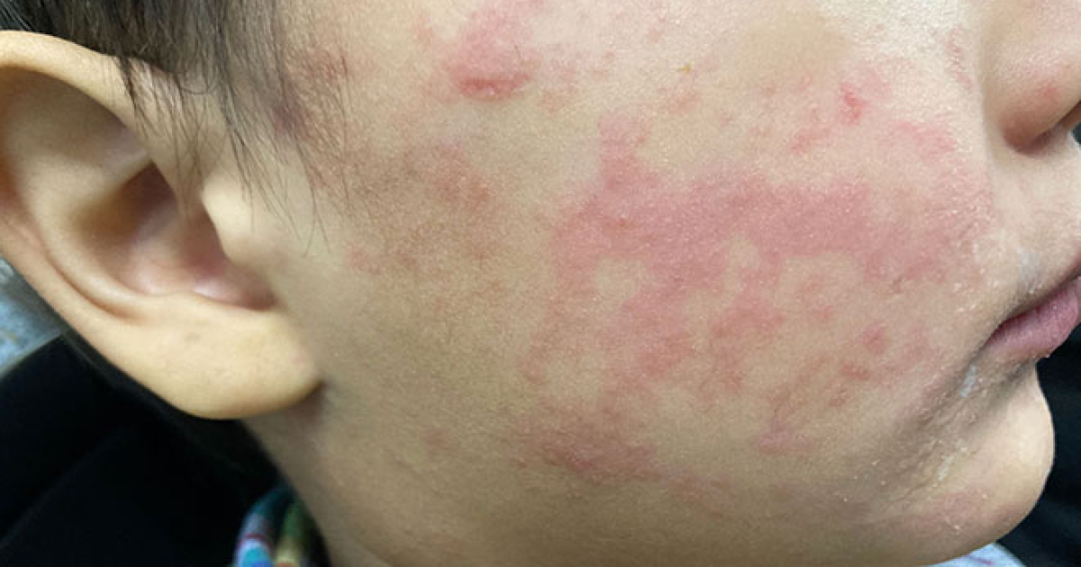 Six confirmed measles cases, 14 presumed infected across upstate NY - WXXI News