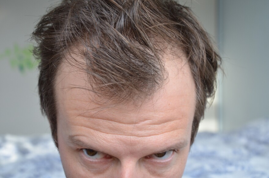 How pandemic stress can lead to hair loss | KERA News