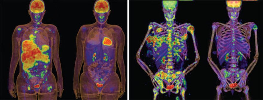 Images of tumors, courtesy of the National Cancer Institute.