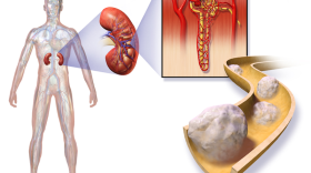 An estimated 65,340 new cases of kidney cancer will occur in the U.S. this year.