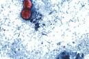 The one-celled cyclospora parasite invades the intestines and causes diarrhea and other digestive symptoms.