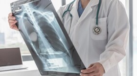 Doctor diagnosing patient’s health on asthma, lung disease, COVID-19 or bone cancer illness with radiological chest x-ray film for medical healthcare hospital