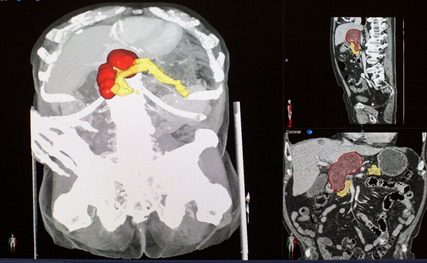 Zinreich digitally paints the pancreas (yellow) and a tumor (red) in a CT scan.
