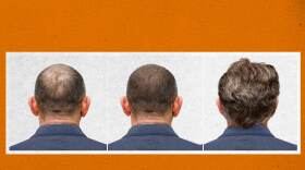 UVA scientists found stem cells in balding scalps — cells that, in sufficient number, could be stimulated to promote new hair growth.