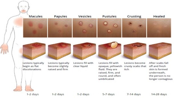Mpox stages