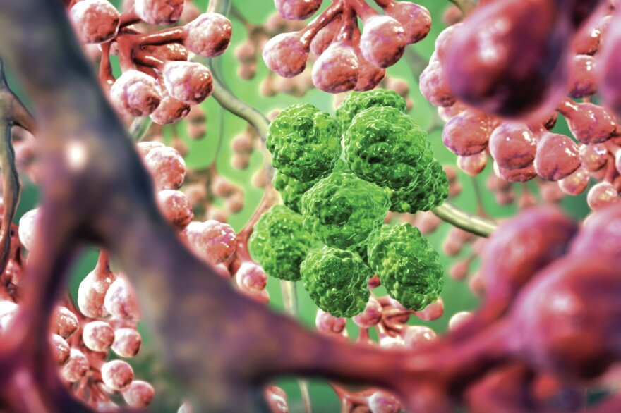 An artist's illustration shows lung cancer cells lurking among healthy air sacs.