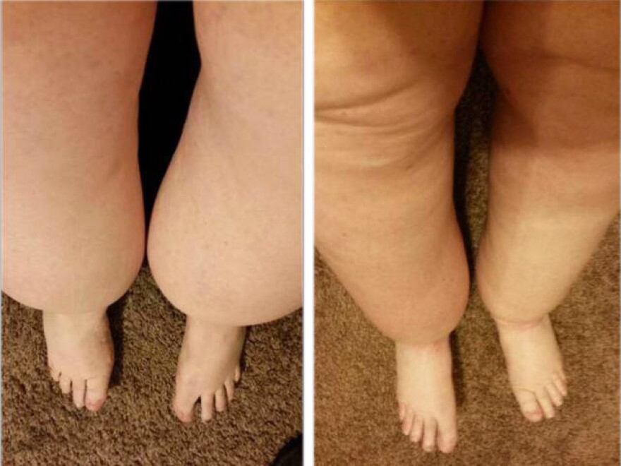 Marlene Simpson's legs before surgery (left) and one month after.