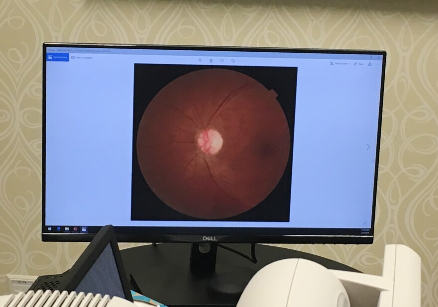 A retinal scan is displayed at University Medical Center in New Orleans using software detects is called diabetic retinopathy.