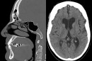 San Antonio researchers are working to uncover traumatic brain injuries in veterans through AI analysis of speech patterns.