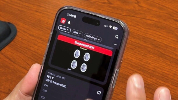 a hand holding a smart phone with brain images from Rapid AI on the screen.