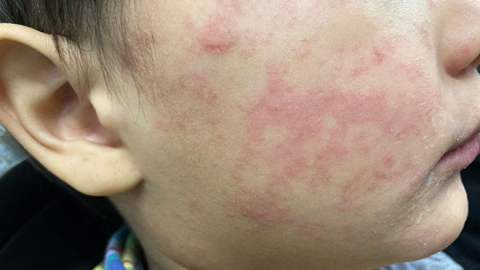 The child’s cheek shows the characteristic rash associated with measles.