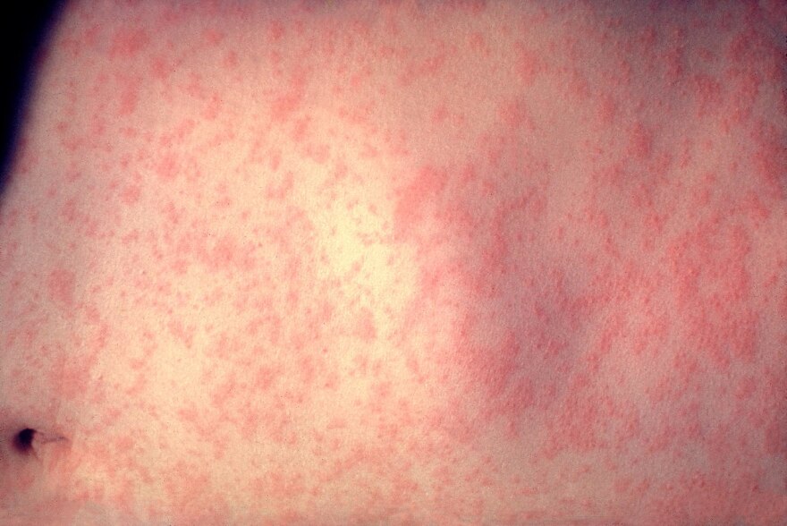 The skin of a patient after 3 days of measles infection.