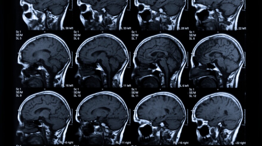 The main goal in stroke treatment: saving brain.