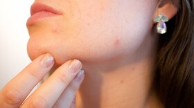 Pimples can appear anywhere on the body.