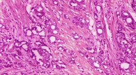 This 1974 microscope image made available by the Centers for Disease Control and Prevention shows changes in cells indicative of adenocarcinoma of the prostate. One study has uncovered some disparities in how racial and ethnic groups are screened for prostate cancer, while a second survey shows that Black men are responding better to a hormonal treatment combination than white men. (Dr. Edwin P. Ewing, Jr./CDC via AP)