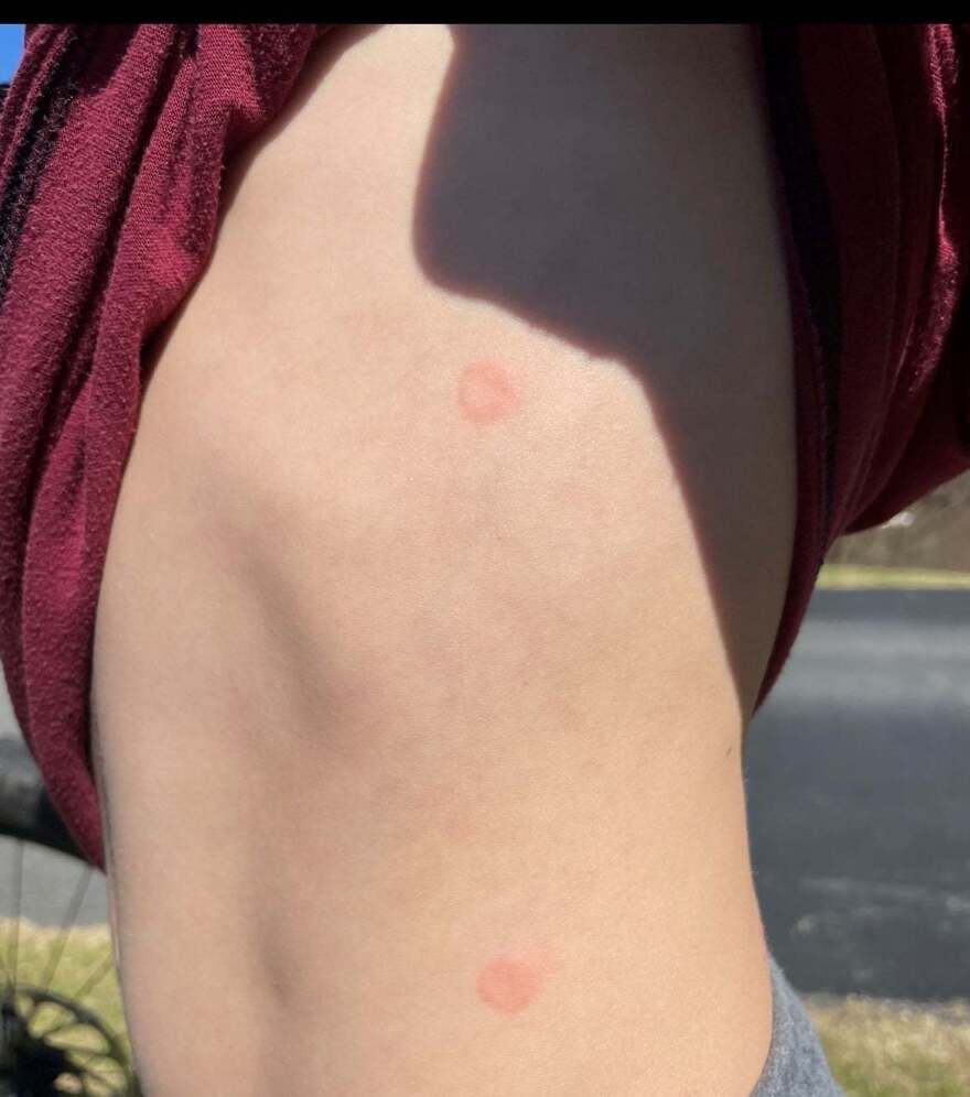 Orbeez balls leave a mark on skin