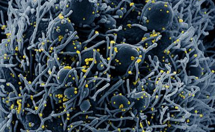 A scanning electron micrograph shows a cell infected with coronavirus particles isolated from a patient sample.