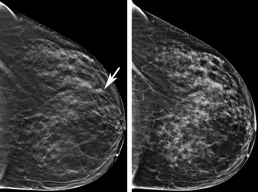 The mammogram image on the left is a 3D image showing an abnormality where the arrow is pointing. In the 2D image on the right, the abnormality is less clear. The patient underwent biopsy, which revealed breast cancer.