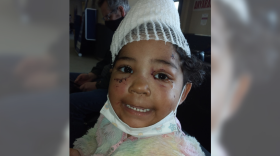 Amaya Santillana, 3, after her surgeries in Anchorage on April 19, 2021. 