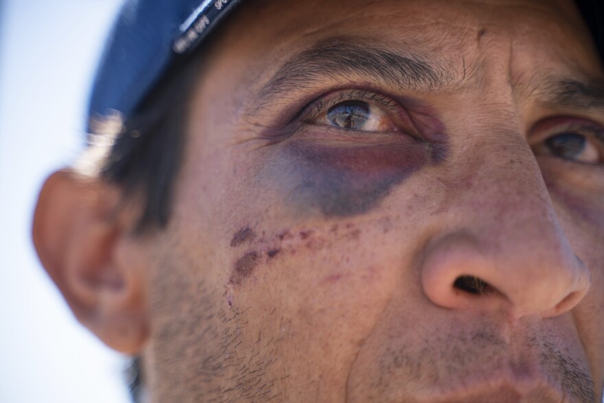 Serafin Aguilera Perez, 39, from Havana, Cuba, shows bruises on his face that he says he sustained after he was attacked by two people who tried to take money that his sister had wired to him.