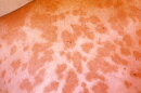 cdc valley fever rash