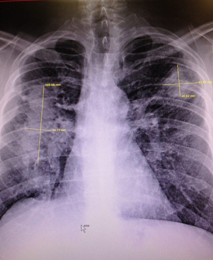 msha-safer-xray.jpg