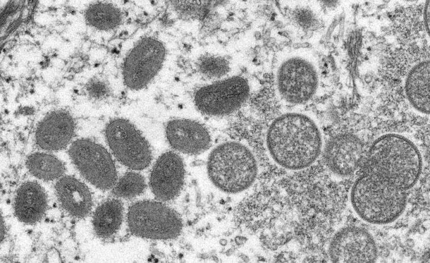 An electron microscope image of a sample of human skin showing mature, oval-shaped monkeypox virions, left, and spherical immature virions, right.