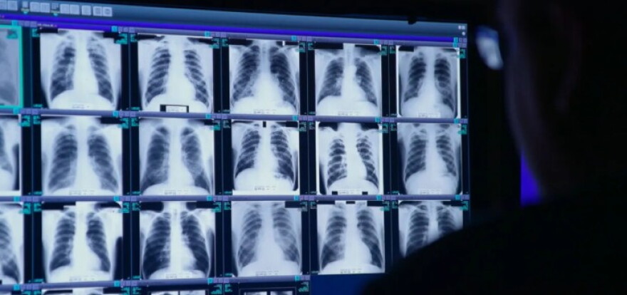 Radiologist Brandon Crum scrutinizes images of coal miners' lungs in his clinic in Coal Run Village, Kentucky. All the lungs shown here are riddled with fibrotic tissue, the breath-stealing signature of black lung disease.