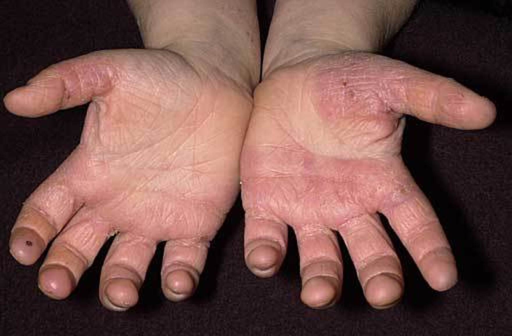 Sore Hands No More HPPR