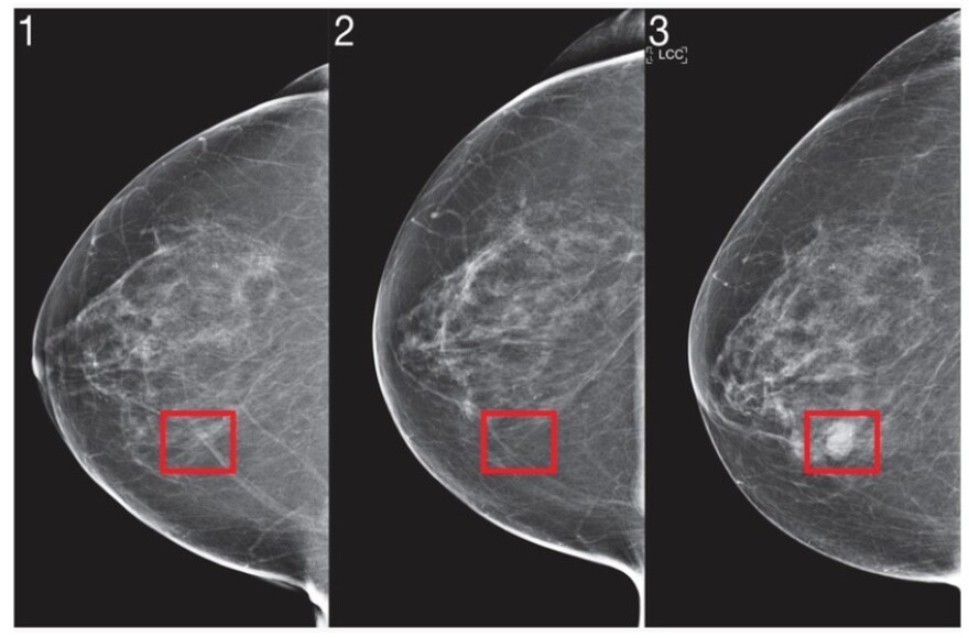 MIT researchers use artificial intelligence to predict breast cancer.