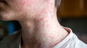 This stock image shows a person with measles.