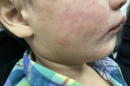 This photograph, taken in the United States depicts a child who was infected with the Morbillivirus, also known as measles, or rubeola during a domestic outbreak in 2024. The child’s cheek shows the characteristic rash associated with this viral infection.