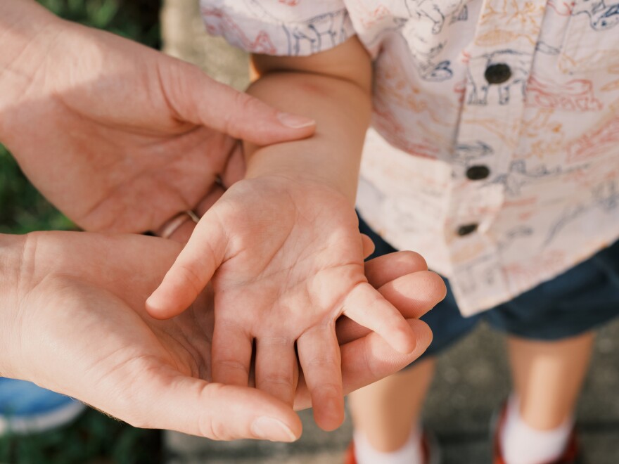 Keeling McLin, now 5, burned his hand on a stove last Memorial Day weekend.