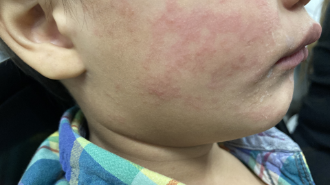 This photograph, taken in the United States depicts a child who was infected with the Morbillivirus, also known as measles, or rubeola during a domestic outbreak in 2024. The child’s cheek shows the characteristic rash associated with this viral infection.