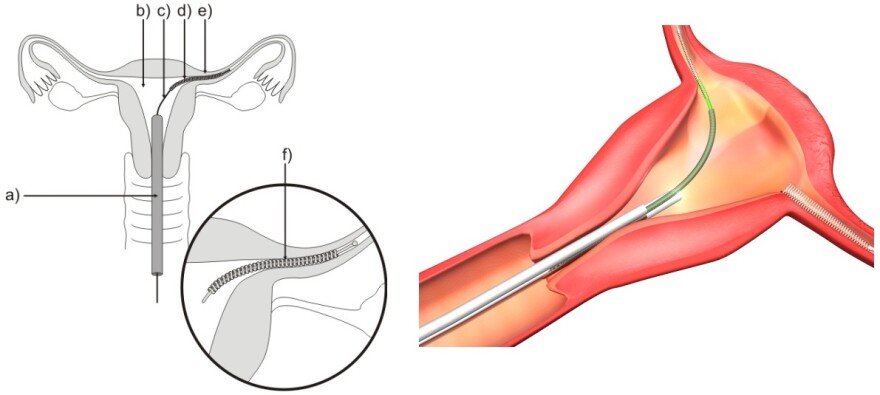 Diagram showing the insertion of the sterilization device Essure, a metal coil placed in the Fallopian tubes. On Thursday, advisers recommended the FDA collect more safety data on the device, which has been on the market since 2002.