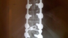 Back injuries are a common workers' compensation claim.