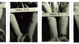 These historical photographs depict the forearms of human test subjects after being exposed to nitrogen mustard and lewisite agents in World War II experiments conducted at the Naval Research Laboratory in Washington, D.C.