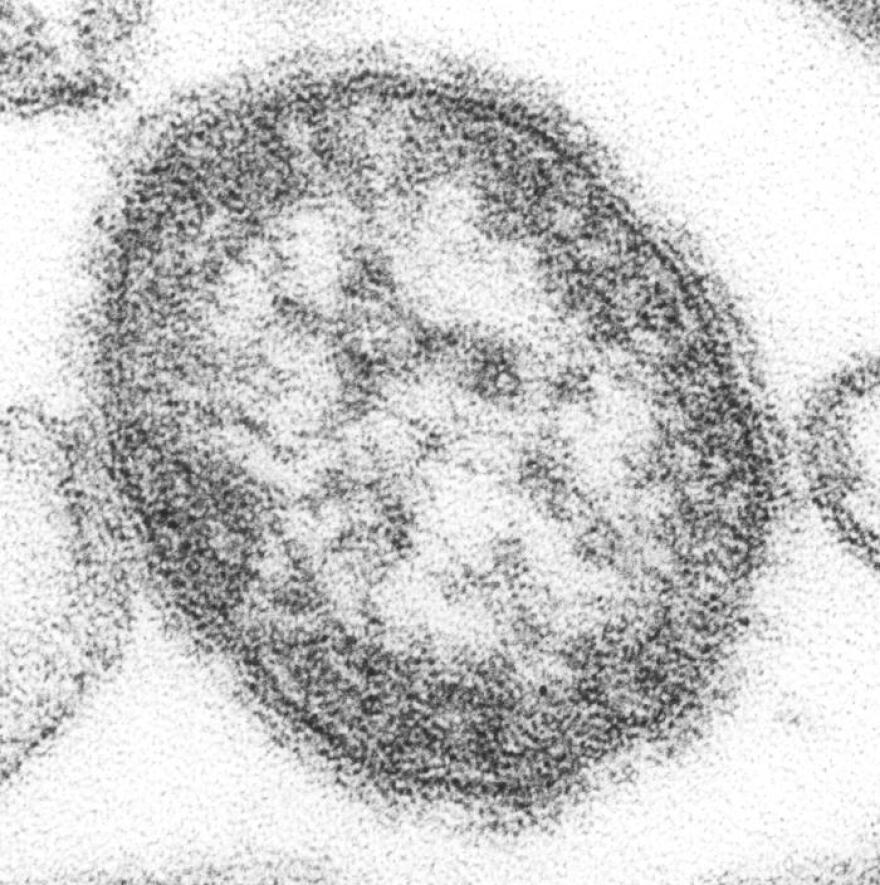 A single measles virus particle, viewed through an electron microscope.