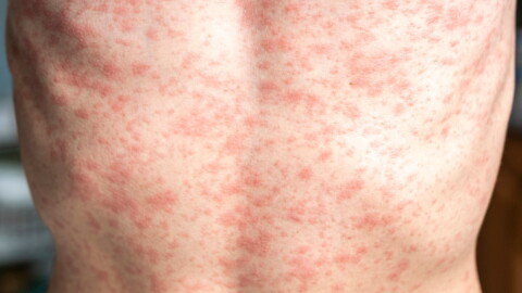 This stock image shows a person's torso covered in a measles rash.