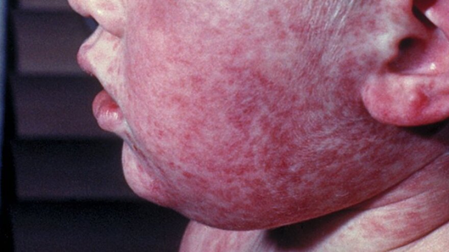 Measles in Michigan.