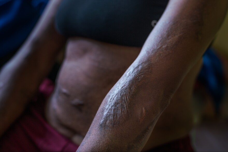 Margaret Kambao shows the scars from burns she suffered in 2015, when she was accused of sorcery and tortured by her community in Enga Province.